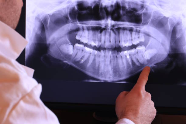 Best Emergency Tooth Extraction in Glendive, MT