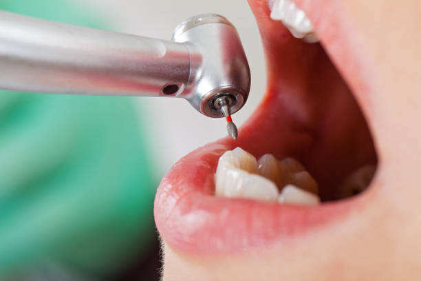 Best Emergency Tooth Extraction in Glendive, MT